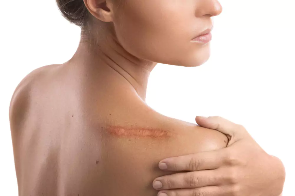 Scar Revision