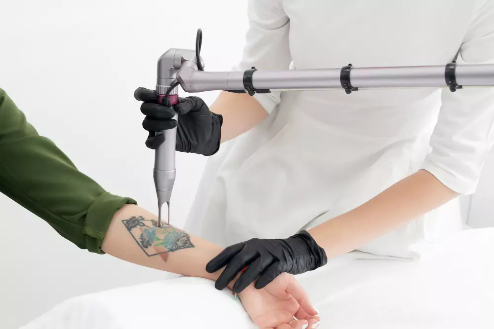 Tattoo Removal